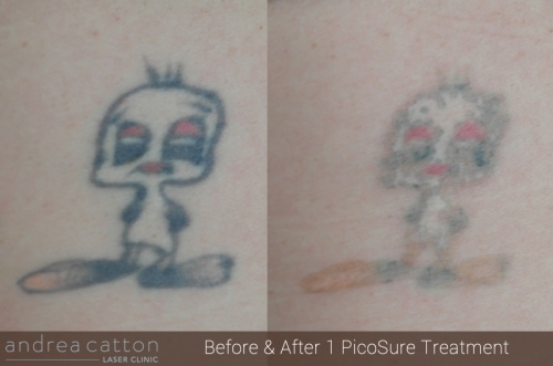 Andrea Catton Laser Clinic Ltd, Tattoo Removal In Burnley