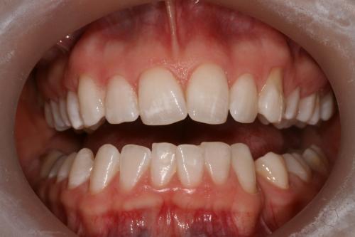 Teeth whitening after