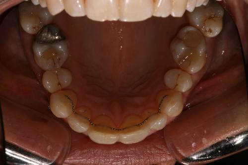 Invisalign straightening after