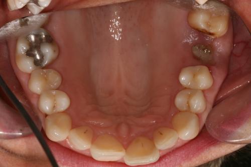 Invisalign straightening before