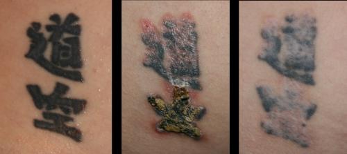 Non Laser Tattoo Removal 4 Less London In London - Beauty Consultants ...