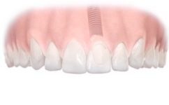 Implant Single After