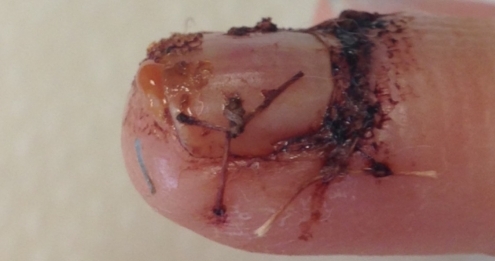 Example of finger injury