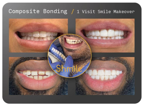 Composite Bonding