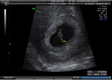 Early Pregnancy Scan
