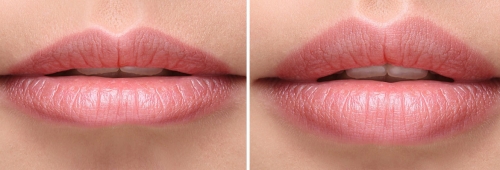 Lip Enhancement